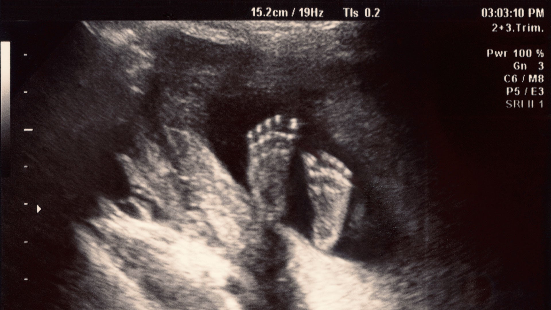 Беременность 19 20 недель фото узи