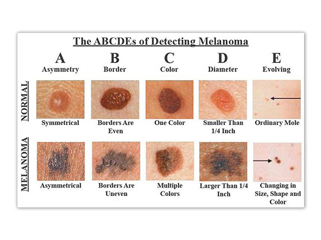 Melanoma Monday: These 5 Little Facts Could Save Your Life | CBN News